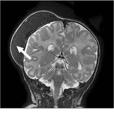 Chronic Subdural Hematoma in A 2 Years-Old Child A Dark Side  in Jacobsen Syndrome